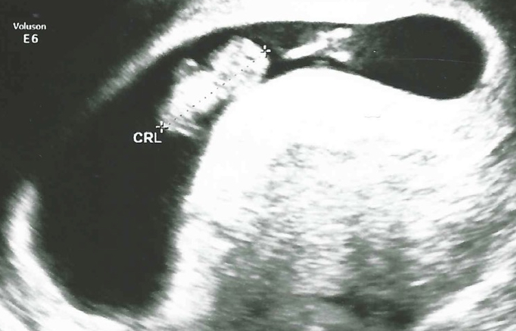 Een echo na 8 weken.