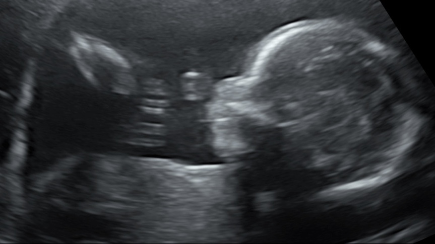 Een echo na 21 weken.
