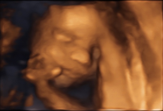 Een echo na 25 weken.